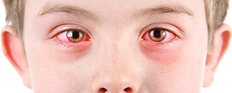Por qué pican los ojos?